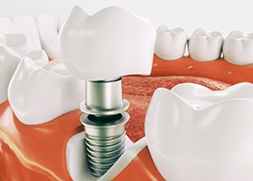 Diagram highlighting the components of a dental implant in Leawood