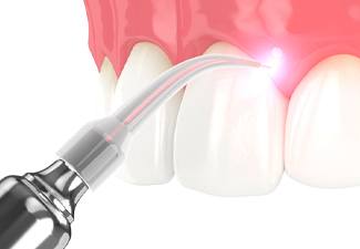 Illustration of laser dentistry