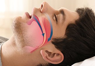 man snoring with diagram showing nasal passage