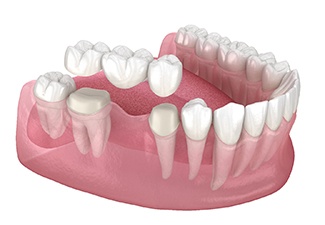 Illustration of dental bridge in Leawood, KS for lower arch