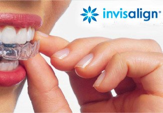 woman putting in invisalign