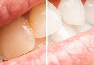 before and after whitening