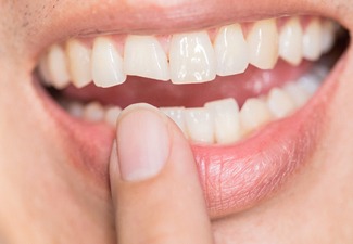 Photograph of a badly chipped tooth