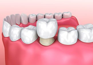 illustration of dental crowns