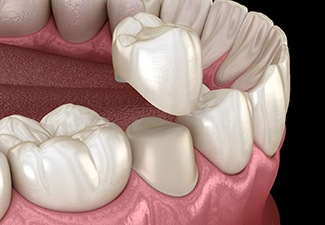 dental crowns