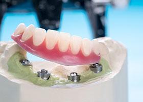 a model showing how implant dentures work