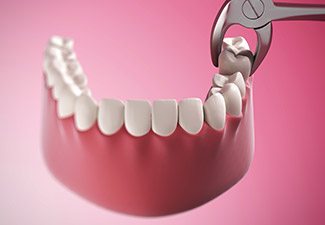 illustration of tooth extraction