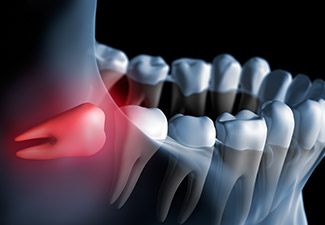 illustration of impacted tooth