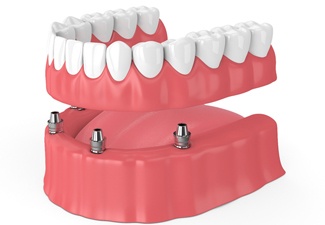 Implant-retained denture