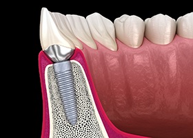 Diagram of an integrated dental implant in Leawood