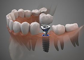 Diagram highlighting components of a dental implant in Leawood