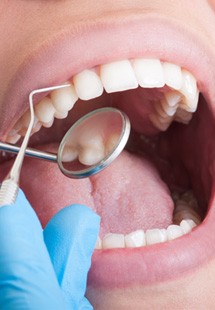 Dental mirror examining a patient’s mouth