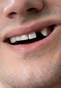 Dentist holding a dental implant crown and full mouth model