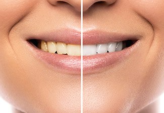 whitening before and after