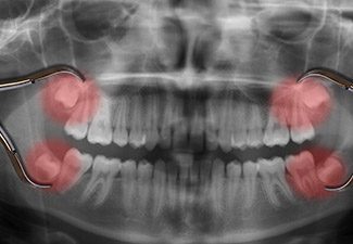 x-ray of wisdom teeth