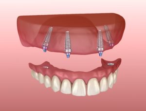 Digital model of implant dentures in Leawood