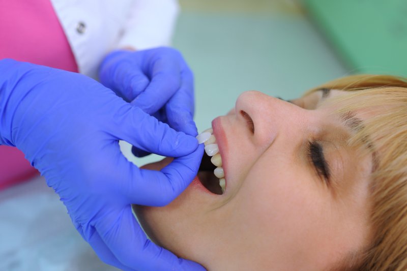 A dentist putting a veneer on a woman’s tooth